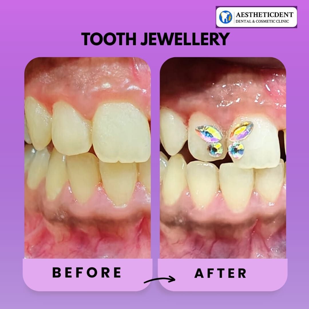Why Kachiguda Residents Are Choosing AestheticDent for Cosmetic Dentistry
